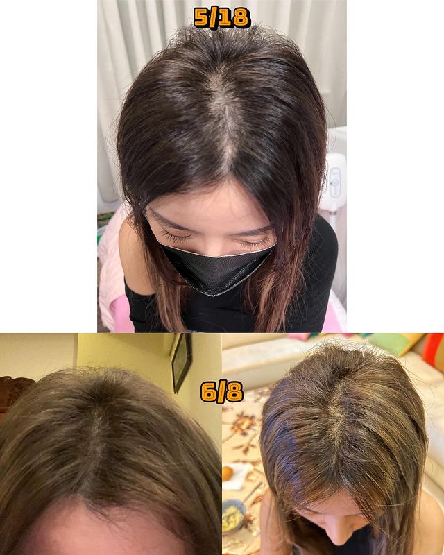 【細胞治療＿產後掉髮】當媽媽更要愛自己！產後掉髮的困擾有解了！